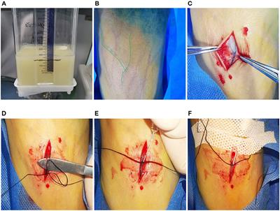 Preliminary Exploration of Transpedal Lymphangiography With High-Dose Ethiodized Oil Application in the Treatment of Postoperative Chylothorax